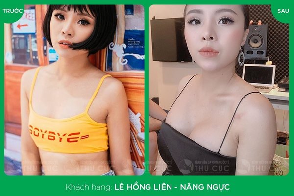Nâng ngực nội soi tại Thu Cúc giúp bạn sở hữu khuôn ngực đẹp tự nhiên, an toàn tuyệt đối