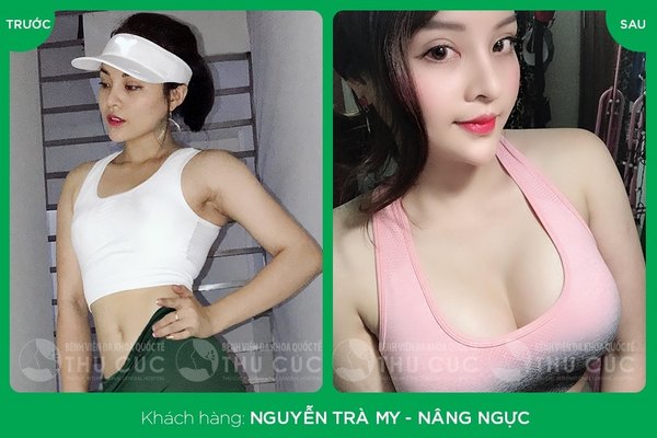 Thu Cúc cam kết bảo hành túi độn trọn đời cho bất cứ khách hàng nào thực hiện nâng ngực (Lưu ý: Kết quả tùy thuộc cơ địa mỗi người)