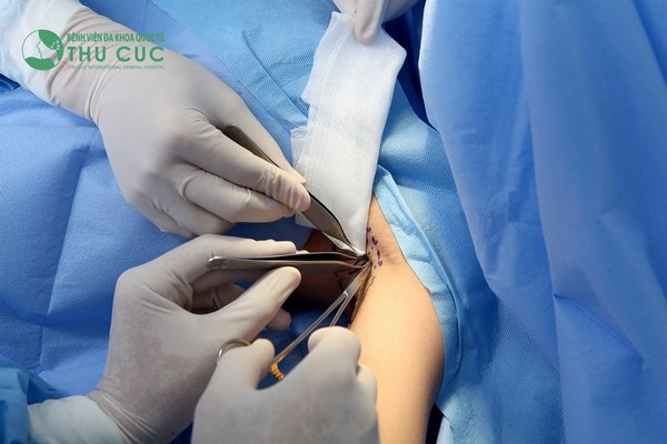 Các bác sĩ thực hiện cắt tuyến mồ hôi nách cho khách hàng