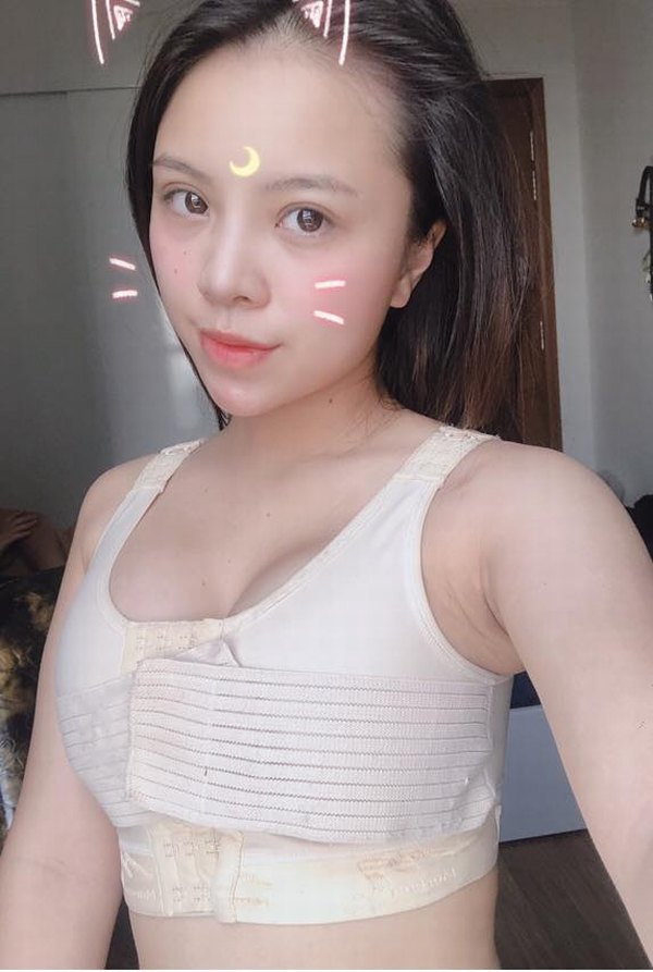 Mặc áo định hình là điều rất quan trọng sau khi nâng ngực