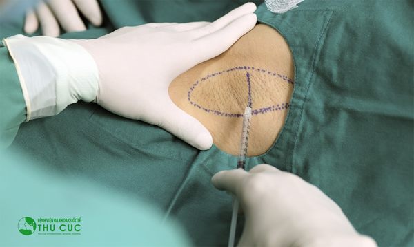Tiêm botox cho hiệu quả trị hôi nách nhanh, không đau, không để lại sẹo