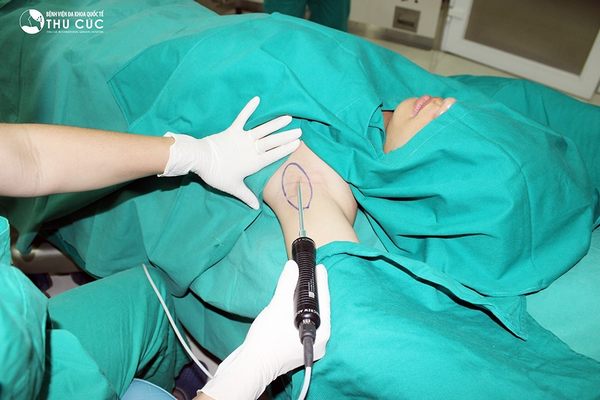 Công nghệ Vaser Lipo giúp loại bỏ mùi hôi nách nhẹ nhàng, không để lại sẹo