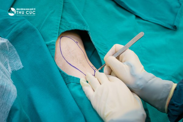 Căt tuyến mồ hôi giúp điều trị hôi nách dứt điểm, vết sẹo rất nhỏ và thẩm mỹ