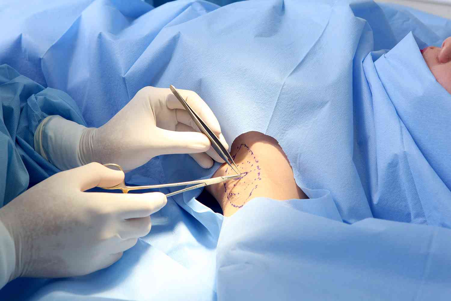 Trị hôi nách ở đâu tốt nhất Sài Gòn?