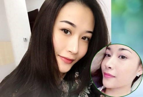 Diện mạo mới của Diệu Linh (24 tuổi) sau nâng mũi S line tại Thu Cúc nhận được nhiều sự khen ngợi của bạn bè người thân
