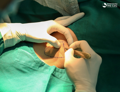 Chỉ sau 20 phút thực hiện, mùi “viêm cánh” đã không hẹn mà… biến mất