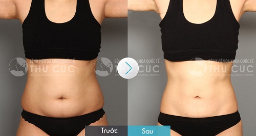 Hiệu quả sau khi hút mỡ bụng bằng sóng siêu âm tại Thu Cúc