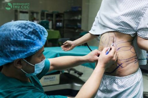 Cũng như nữ diễn viên Đàm Hằng, nhiều chị em khác có chung tâm trạng tự ti về thân hình thiếu thon gọn đã trải nghiệm công nghệ hút mỡ Vaser Lipo.