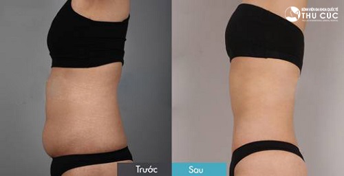 Đặc biệt, sau khi “xóa sổ” lượng mỡ thừa trên cơ thể, năng lượng sóng siêu âm còn kích thích sản xuất collagen, giúp làn da vùng điều trị săn chắc, trẻ hóa mịn màng.