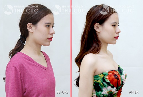 Sự thay đổi trước và sau khi thực hiện nâng ngực nội soi tại Thu Cúc