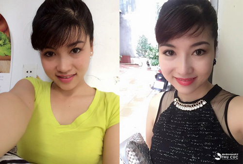 Khuôn mặt của bà mẹ U30 vẫn không khác thời thiếu nữ. Chỉ với sự thay đổi nhỏ dáng mũi trên gương mặt giúp chị Thảo đẹp quyến rũ hơn nhiều (Lưu ý: hiệu quả thẩm mỹ có thể khác nhau tùy theo cơ địa từng người)