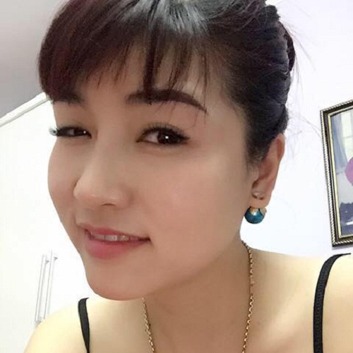 Sau khi thấy được nhược điểm trên chiếc mũi thấp của mình, chị Thảo đã quyết định đến Bệnh viện Thu Cúc để thực hiện nâng mũi Sline. Kỹ thuật nâng mũi hiện đại được bác sĩ thực hiện nhẹ nhàng, nhanh chóng nên chị thấy khá hài lòng