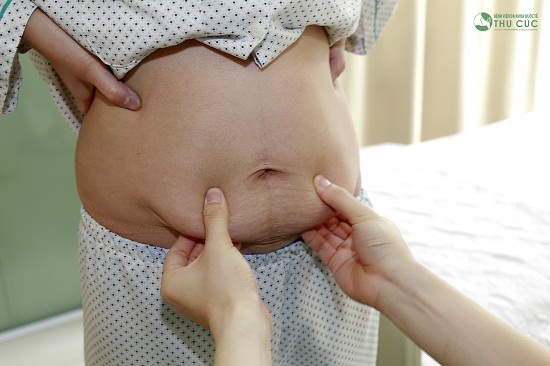 Lượng mỡ thừa ở bụng là nỗi khổ tâm của không ít chị em sau sinh.