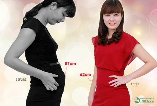 Chị Thanh Tâm đã giảm nhanh được 25cm vòng eo. (Lưu ý: Kết quả thẩm mỹ có thể khác nhau tùy theo cơ địa từng người)