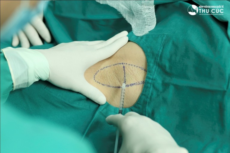 Bác sĩ thẩm mỹ tiến hành gây tê cục bộ vùng nách trước khi hút tuyến mồ hôi để tạo cảm giác nhẹ nhàng cho khách hàng
