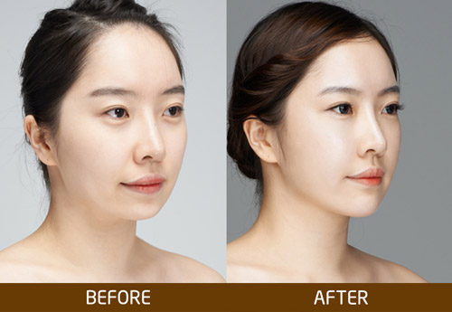 Tiêm chất làm đầy làm đẹp có ưu điểm vượt trội là mang đến vẻ hoàn hảo, tự nhiên cho khuôn mặt. * Lưu ý: Kết quả có thể khác nhau tuỳ cơ địa của từng người