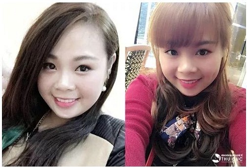 Nụ cười xinh hút hồn của cô bạn Phương Dung sau thẩm mỹ tạo má lúm tại Thu Cúc (Lưu ý: Kết quả thẩm mỹ có thể khác nhau tùy theo cơ địa mỗi người)