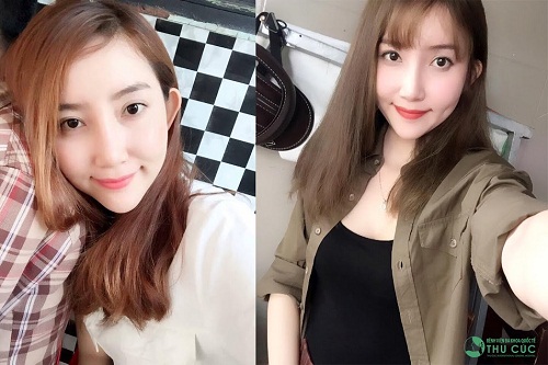 So sánh 2 bức ảnh có thể thấy nụ cười của Tố Quyên cuốn hút, rạng rỡ và đáng yêu hơn rất nhiều sau khi có thêm chiếc má lúm xinh xắn. (Lưu ý: Kết quả có thể khác nhau tùy cơ địa của từng người)