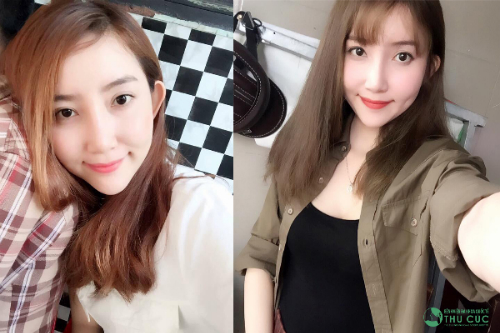 So sánh 2 bức ảnh có thể thấy nụ cười của Tố Quyên cuốn hút, rạng rỡ và đáng yêu hơn rất nhiều sau khi có thêm chiếc má lúm xinh xắn. (Lưu ý: Hiệu quả thẩm mỹ có thể khác nhau tùy theo cơ địa từng người)