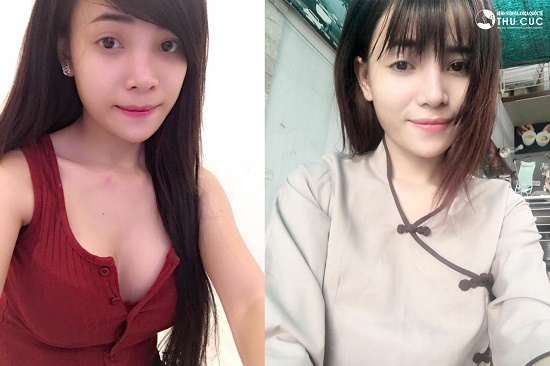 Và cũng như lần nâng ngực trước đó, Vivi An cũng cảm thấy rất hài lòng với chiếc mũi cao tự nhiên, không có sẹo, không lộ dấu vết “dao kéo”.