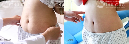 Mỡ bụng sau sinh cộng thêm tính chất công việc phải ngồi nhiều khiến mỡ bụng của Mai ngày càng nhiều. Sau thẩm mỹ, những ngấn mỡ thừa dường như đã biến mất nhờ công nghệ hút mỡ Vaser Lipo và tạo hình bụng đặc biệt. (Lưu ý: hiệu quả thẩm mỹ có thể khác nhau tùy theo cơ địa mỗi người)