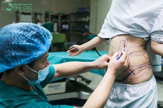 Để những thao tác phẫu thuật đạt độ chính xác cao, các bác sĩ giúp cô đo vẽ thẩm mỹ, khoanh vùng khu vực bụng cần được phẫu thuật…