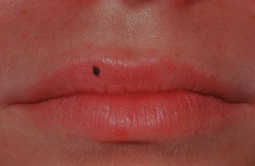 Tẩy nốt ruồi ở môi