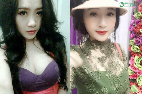 9x Hà Trang sở hữu mũi đẹp chuẩn Hàn sau thẩm mỹ