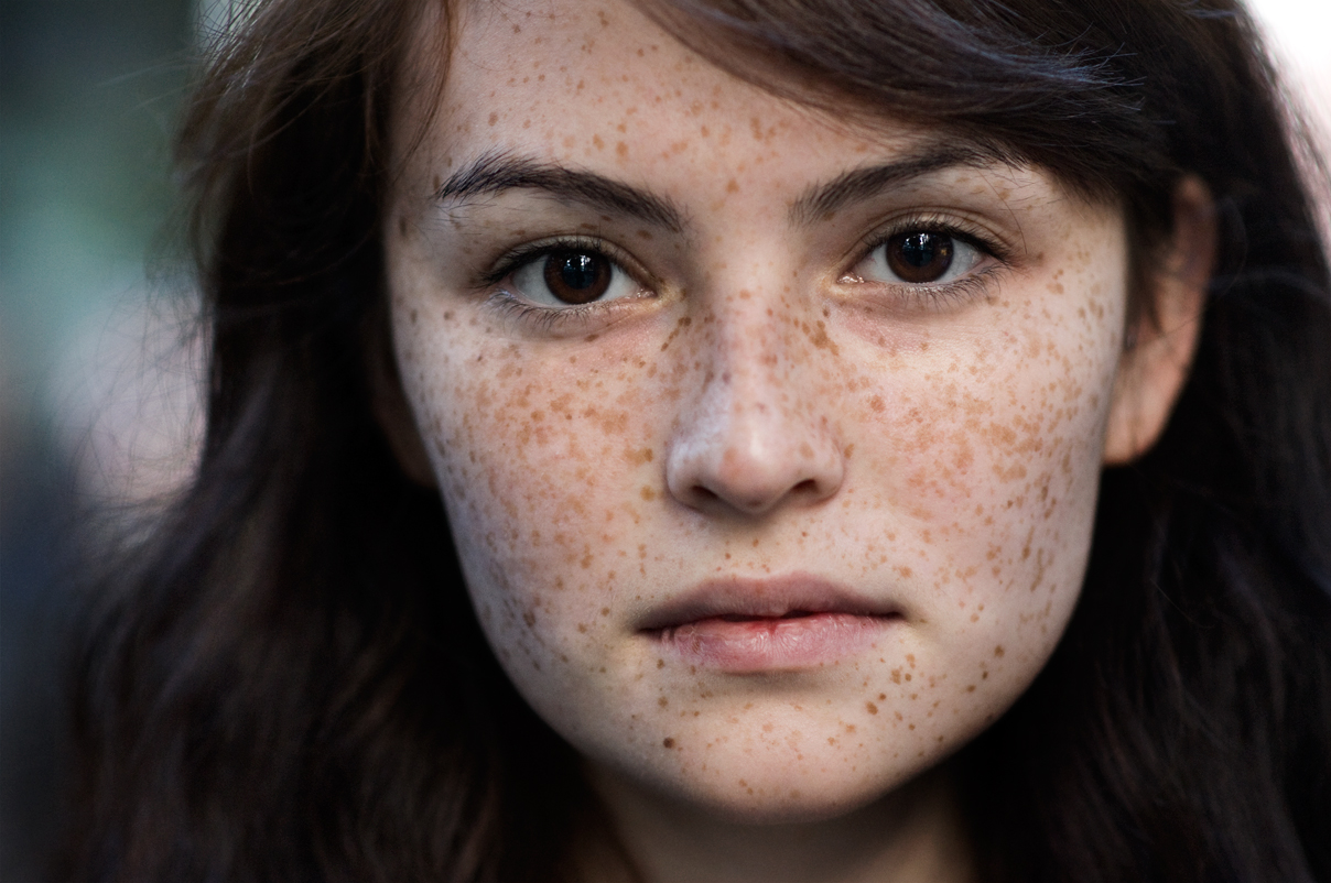 Tàn nhang thường xuất hiện nhiều trên mặt, đặc biệt là vùng má và quanh mắt