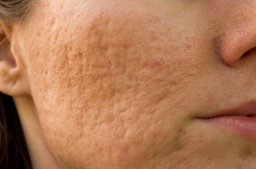 Có cách nào trị sẹo lõm lâu năm trên mặt?