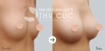 Có nên nâng ngực nội soi
