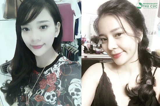 Là một cô gái năng động, trẻ trung, Phương Mai không ngần ngại chọn nâng mũi bọc sụn để làm đẹp ngoại hình. (Lưu ý: Hiệu quả thẩm mỹ có thể khác nhau tùy theo cơ địa từng người)