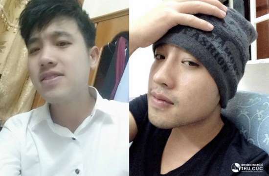Điển hình là chàng kỹ sư Nhữ Văn Thành, sau nâng mũi S line tại Thu Cúc, anh đã sở hữu vẻ “chuẩn men” nhờ mũi cao, thon gọn. (Hiệu quả thẩm mỹ có thể khác nhau tùy theo cơ địa từng người)