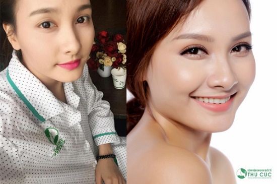 Diễn viên Bảo Thanh trở nên trẻ trung, xinh đẹp hơn với đôi mắt hai mí sâu, linh hoạt sau khi cắt mí tại Thu Cúc. (Hiệu quả thẩm mỹ có thể khác nhau tùy theo cơ địa từng người)