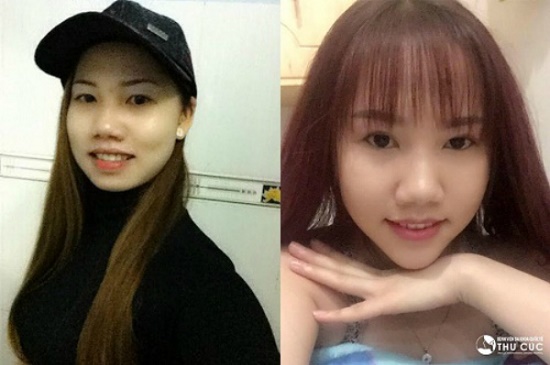 Tuyết Lê ngày càng xinh đẹp kể từ khi thay đổi chiếc cằm vuông, lẹm, thành cằm V line thanh tú, sang chảnh. (hiệu quả thẩm mỹ có thể khác nhau tùy theo cơ địa từng người)