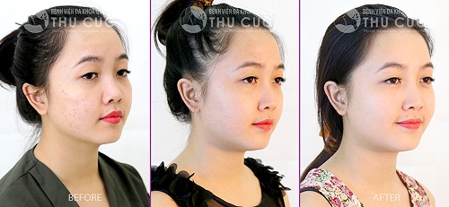 dieu-tri-seo-tham-tren-mat-lau-nam-hieu-qua-2
