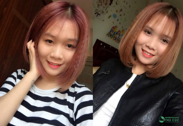 Nhan sắc thay đổi kì diệu chỉ 1 tuần sau cắt mí của cô sinh viên Thùy Linh