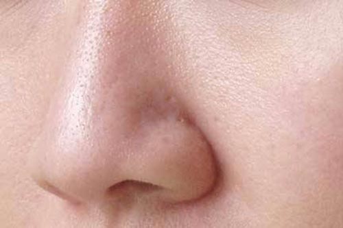 5 mẹo đơn giản làm se khít lỗ chân lông trên da mặt hiệu quả