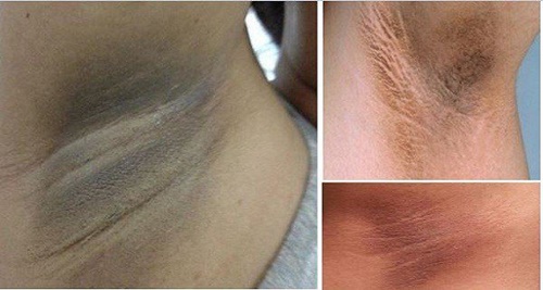 5 nguyên nhân bạn không nên nhổ lông nách