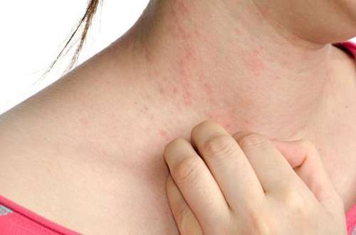 dấu hiệu nhận biết viêm nang lông