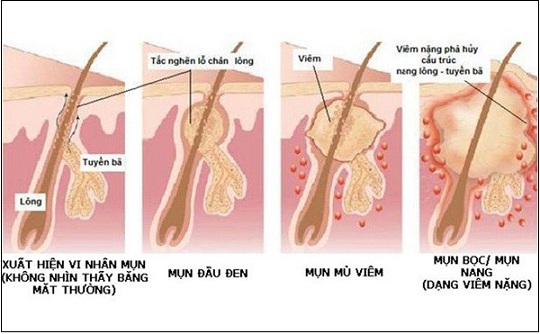 dấu hiệu nhận biết viêm nang lông