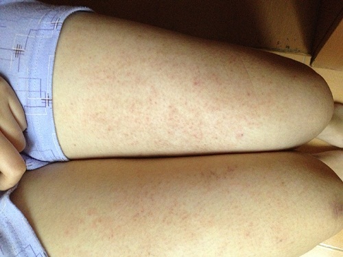 các bệnh thường gặp do tẩy lông không đúng cách