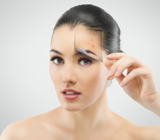 Sẹo thâm xuất hiện trên mặt là hậu quả do mụn để lại, nếu không có biện pháp can thiệp thì sẹo thâm sẽ tồn tại trên da rất lâu.