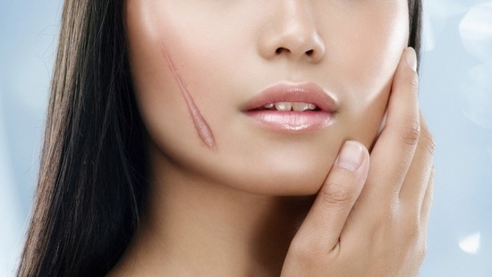 Quá trình liền da sau một số tổn thương rất có thể sẽ để lại sẹo lồi.