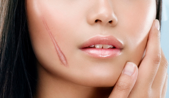 Bình thường các vết sẹo lồi tồn tại ở hình dạng, kích thước giống như vết thương nhưng lồi lên trên bề mặt da.