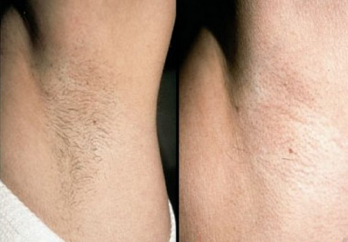 bạn đã biết cách tẩy lông nách không đau không thâm da
