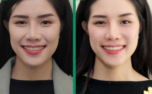 Là một cô gái nhạy bén với các công nghệ làm đẹp, Minh Thúy (sinh năm 1991, mẫu ảnh) quyết định sử dụng dịch vụ tiêm filler để xóa nhăn, làm đầy má hóp. Cô nàng chọn phương pháp này vì thực hiện nhanh, không xâm lấn, có tác dụng liền. Sử dụng chất làm đầy Juvederm để tiêm vào vùng rãnh nhăn khóe miệng và má hóp, kết hợp tạo hình thẩm mỹ, bác sĩ tại Thu Cúc giúp Minh Thúy sở hữu vùng da căng mịn, trắng sáng.