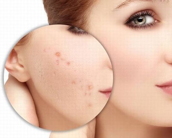 Đặc điểm của sẹo thâm là tạo ra vùng da có màu sậm hơn so với các vùng da khác nên khiến làn da không được mịn màng, không đều màu và loang lổ.