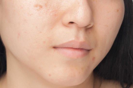 Có nhiều nguyên nhân gây nên sẹo lõm trên da, trong đó nguyên nhân lớn nhất là do các nốt mụn để lại.