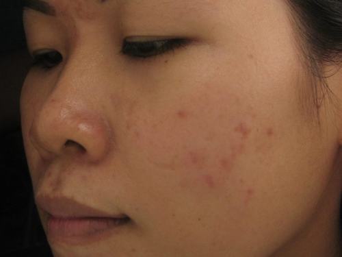 Sẹo trên da là 1 trong những nhược điểm khiến bạn thiếu tự tin vào làn da của mình.
